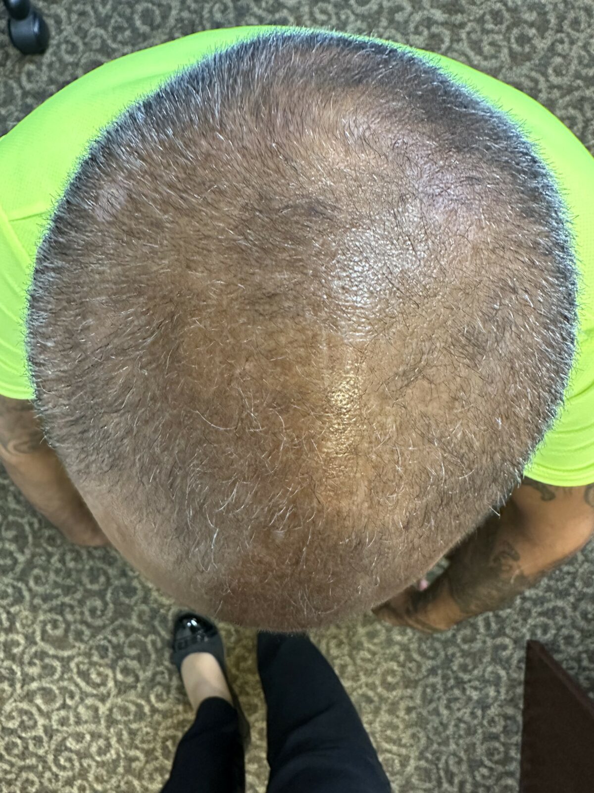 HAIR RESTORATION after