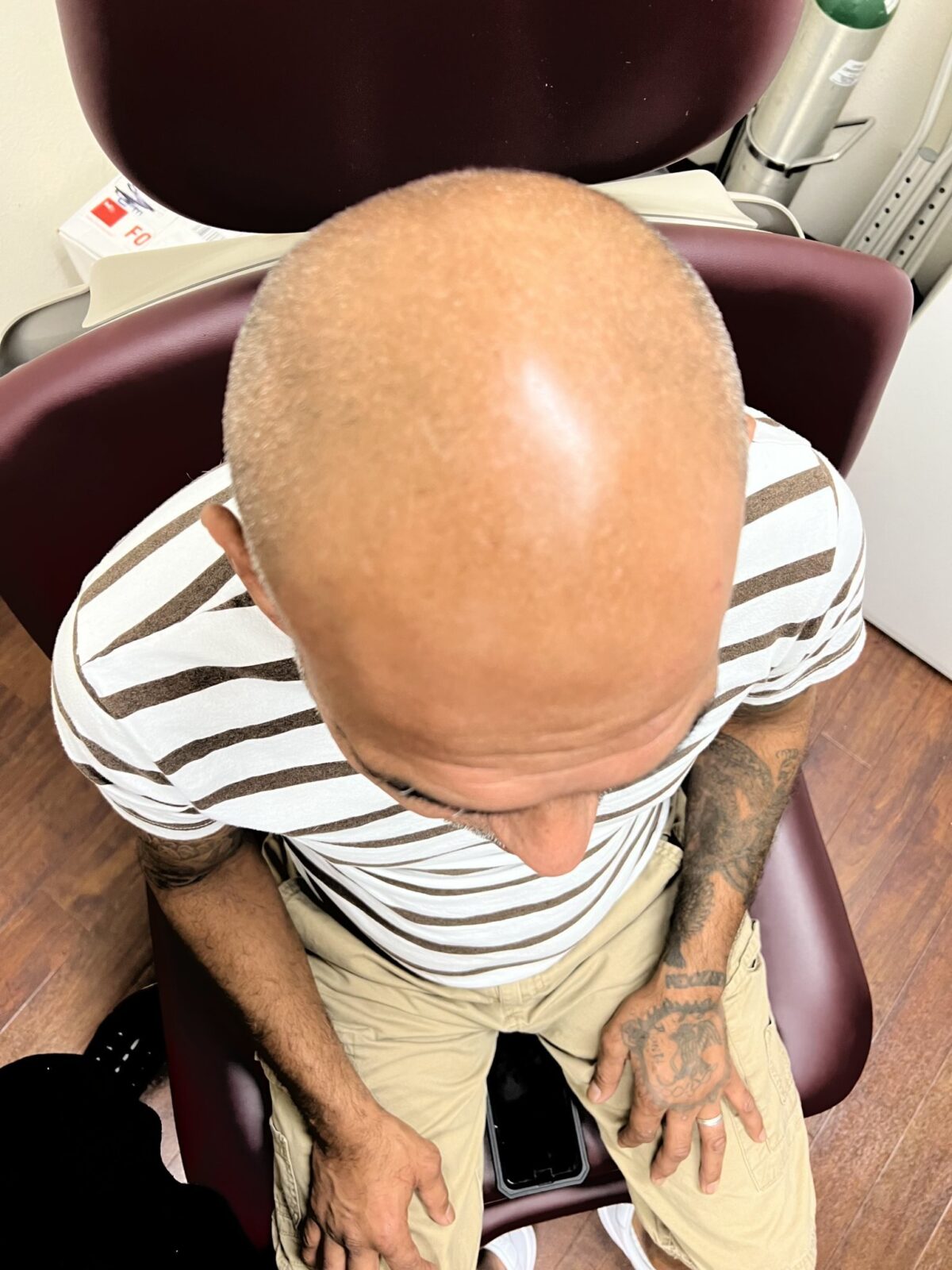 HAIR RESTORATION before