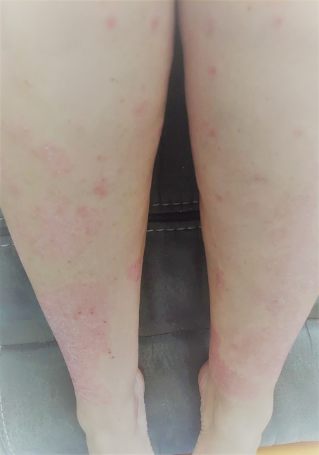 PLAQUE PSORIASIS after
