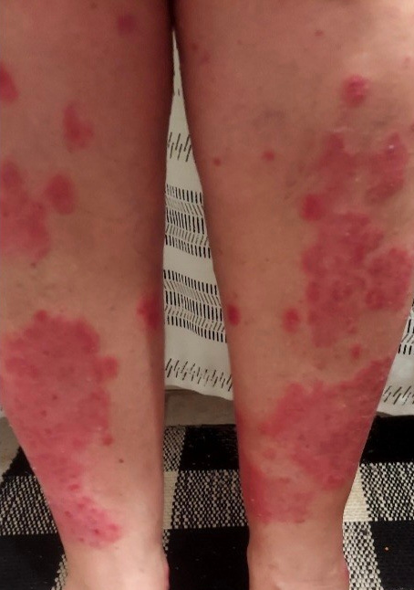 PLAQUE PSORIASIS before
